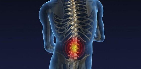 Dor nas costas con osteocondrose do lumbar