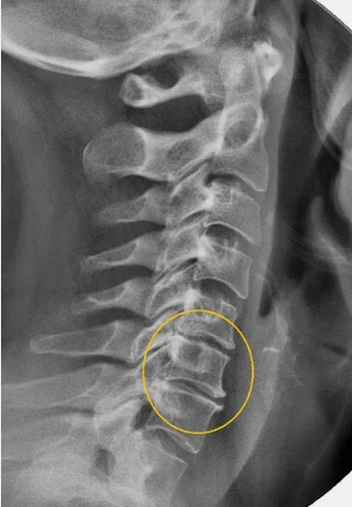 Osteocondrose da columna cervical nun x -ray