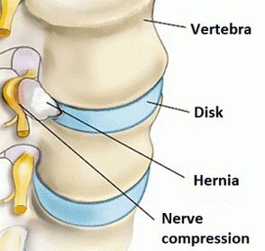 Osteocondrose da rexión cervical