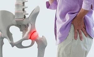 causas da artrose da articulación da cadeira