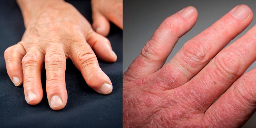artrite reumatoide e psoriásica das mans