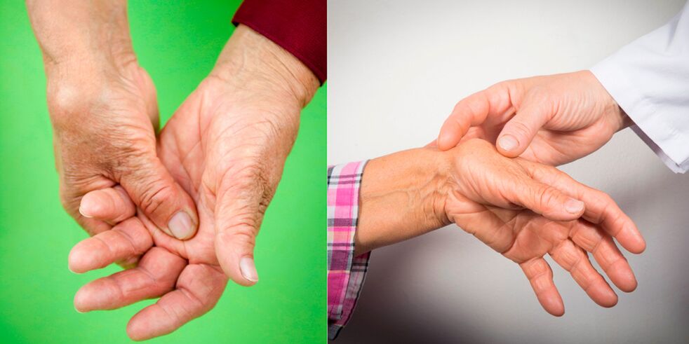 o inchazo e as dores son os primeiros signos de artrite manual
