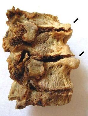 Sección vertebral afectada por osteocondrose