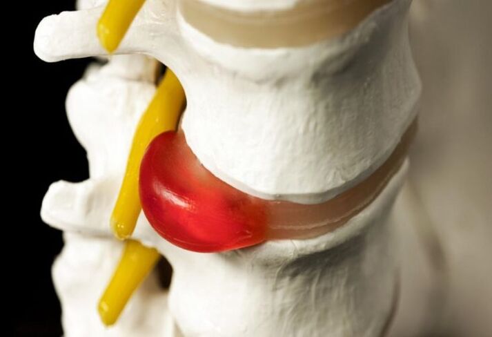 hernia da columna vertebral como causa de dor nos omóplatos