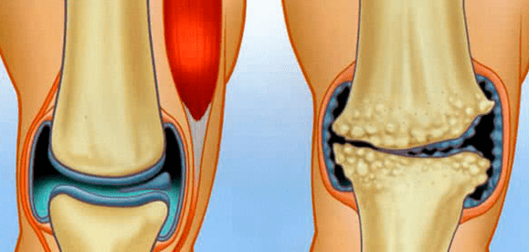 Articulación normal e artrose